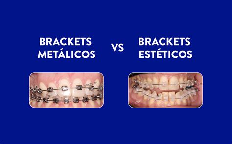 bracket estetico y metalico|brackets metalicos.